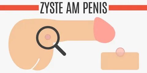 Fordyce drüsen penis Variations in Penile Anatomy and Their 