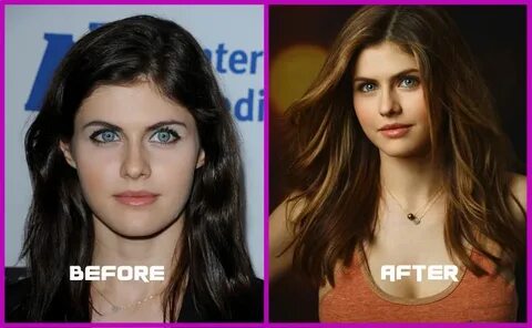 Alexandra Daddario Plastic Surgery Before After, Breast Impl
