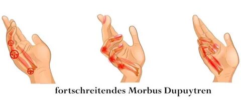 Morbus Dupuytren: Symptome, Behandlung und TOP-Übungen Liebs