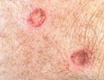 Basal Skin Cancer Scalp