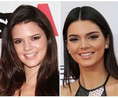 Kendall Jenner before and after Kendall jenner nose job, Ken