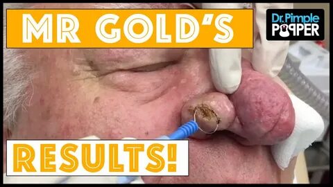 Results after Rhinophyma Treatment, Mr Gold - YouTube