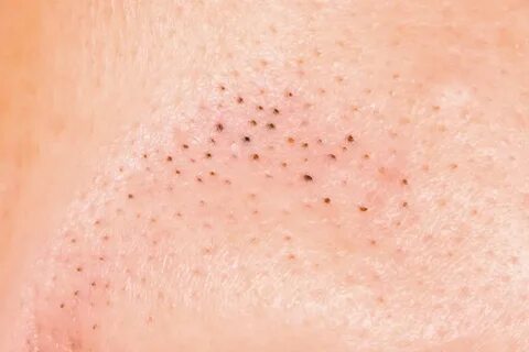 Ways To Prevent And Effectively Treat Blackheads Shinagawa A