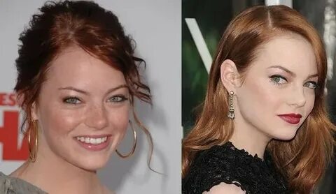 Emma Stone before and after plastic surgery Celebrity plasti