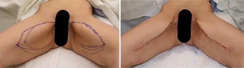 Plastic Surgery Case Study - Vertical Inner Thigh Lifts - Ex