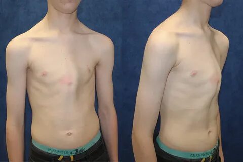 Pectus Carinatum Case Histories