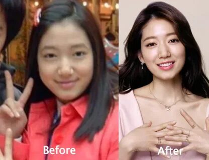 Park Shin Hye Plastic Surgery Before and After Photos