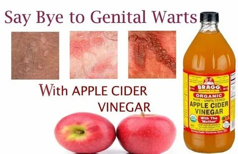 How to Get Rid of Genital Warts Fast With Apple Cider Vinega