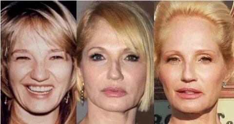 Ellen Barkin Facelift Plastic Surgery Before and After Celeb