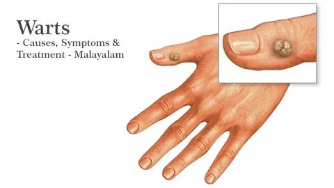 How Warts are removed? - Explained in Malayalam Arimbara Rem