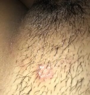 Am I infected with herpes?? Genital Herpes Simplex Forums Pa