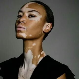 Pin by talia on Apreciação vitiligo Vitiligo treatment, Skin