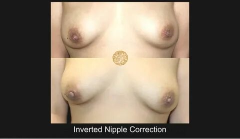 Inverted Nipple Correction Gallery Plastic Surgery