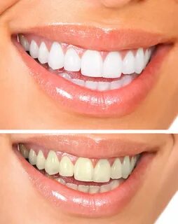 Tooth whitening: Tray-delivered gels showed a slightly bette