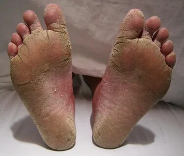 File:FeetFungal.JPG - Wikimedia Commons