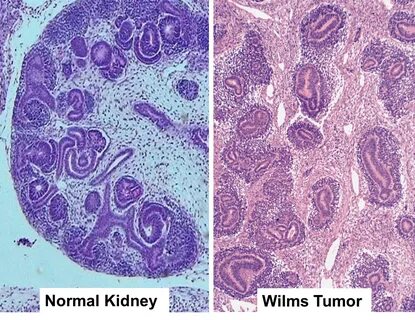 Discovery of Novel Mutations in a Subtype of Wilms Tumor Rev