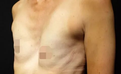 Woman with 'pigeon chest' deformity which left her with CONC