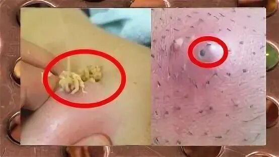 Pimple-popping and cyst-removal videos very satisfying video