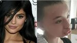 Bibir Remaja Ini Bengkak Gara-Gara Ikutan Kylie Jenner Lip C