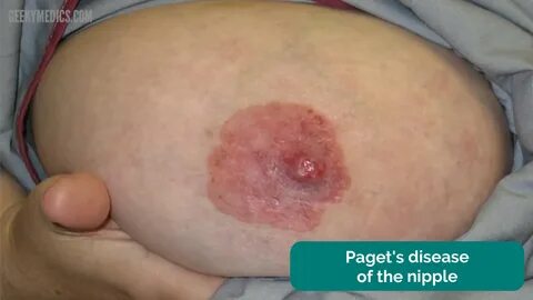 Paget's disease and small bumps on boobs