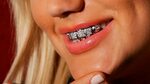 Популярность бриллиантов на зубах россиян объяснили их желан