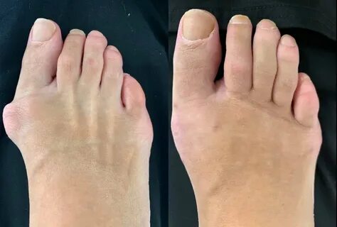 Bunion Surgery Before and After Northwest Surgery Center Wis