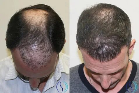 Health And Hairs Corporation Hair Transplant Best Cheap Clin