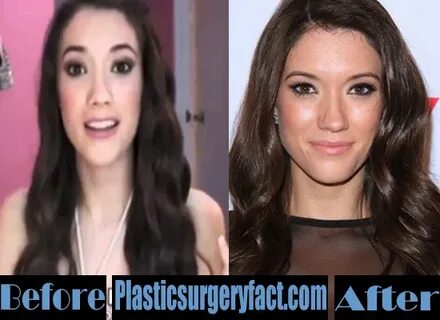 Blair Fowler Nose Job Before and After - Plastic Surgery Fac