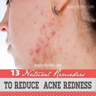 Home Remedies To Reduce Acne Redness Look Good Naturally Acn