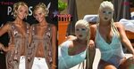 Shannon Twins Plastic Surgery Before After, Breast Implants
