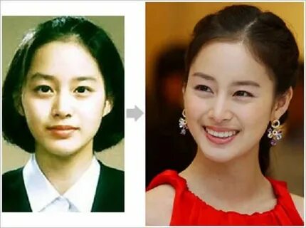 korean stars plastic surgery images Health Pictures of Surge