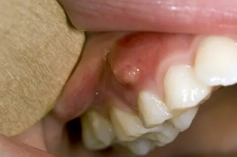 The most Insightful Stories about swollen gums treatment at 