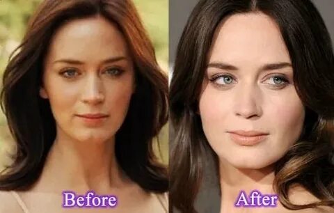 Emily Blunt Plastic Surgery Before After, Breast Implants