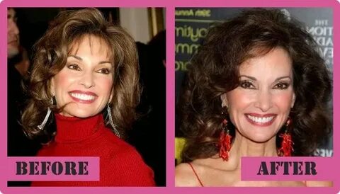 Susan Lucci Plastic Surgery