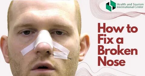 Broken nose - Is surgery always necessary? - HTI CENTERS Med