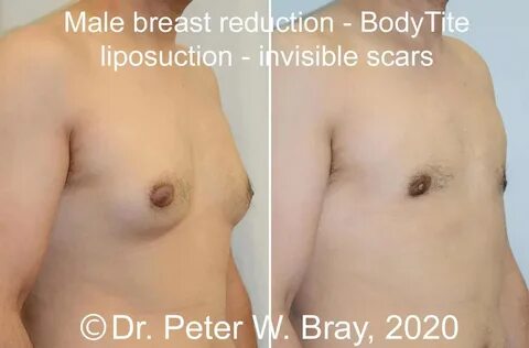 Boob reduction costs