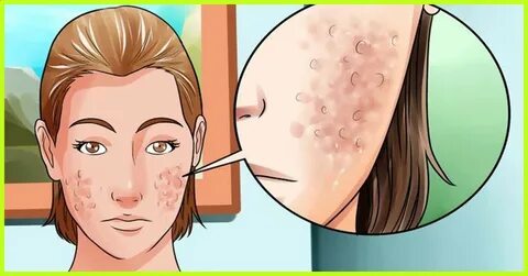 Acne Scarring Home Remedies. Acne scarring domestic treatmen