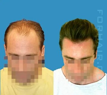 Revolutionary Hair Transplant Technique from Dr. John Cole P