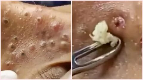 Blackhead Videos On Back : Sign up for free today! - Anabelf