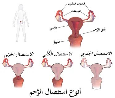 ملف:Hysterectomy-ar.png - ويكيبيديا