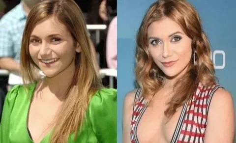 Did Alyson Stoner Undergo Plastic Surgery Including Nose Job