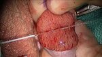 Williams Urology - Sperm Retrieval