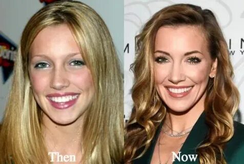 Katie Cassidy Plastic Surgery Before and After Photos