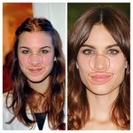 Alexa Chung before and after plastic surgery and injectables