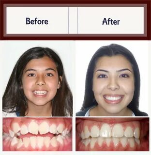 Before and After Orthodontic Treatment Examples Premier Orth