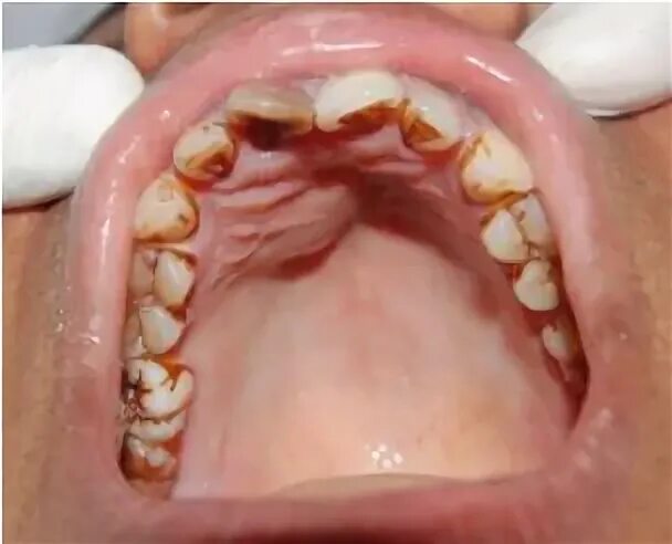 Use of Contrast Radiography to Differentiate Unilocular Cyst