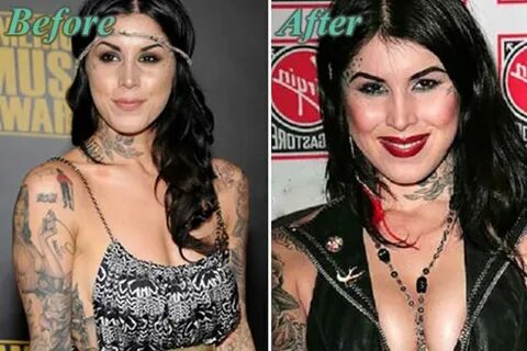 Kat Von D Plastic Surgery - Plastic Industry In The World