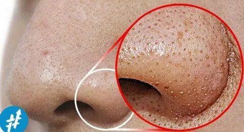 natural way to get rid of blackheads for Android - APK Downl