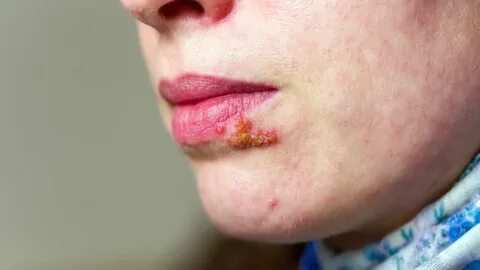 Allt om munherpes (herpes simplex) - symtom, orsak och behan