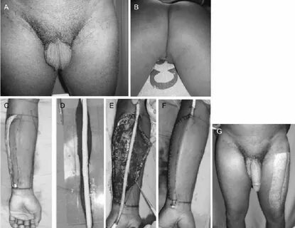 A 38-year-old man who underwent total penectomy and bilatera